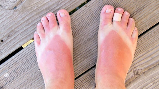 Bí quyết làm trắng da chân bị cháy nắng
