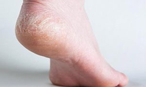 Chăm sóc da chân bị khô đúng cách và hiệu quả
